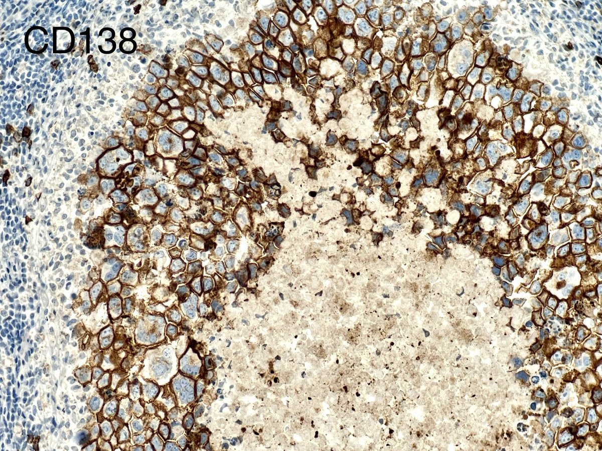 NanaMatsumoto8's tweet photo. Lymphadenopathy in an Immunocompromised male patient. Not an effusion. CD20/PAX5 negative. EMA gorgeously positive. What do you think? #PathTwitter #hemepath https://t.co/DosNEiOxcx