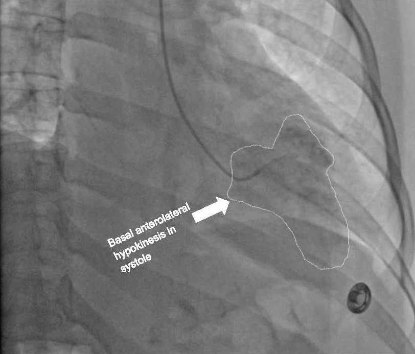 New case report! "A Rare Case of Iatrogenic Inverted Stress Cardiomyopathy” by Drs. Parviz-Ali Lotfian, Arun Umesh Mahtani, Seyed Zaidi, &amp; Richard Grodman <a href="/RUMCSI/">RUMC</a> in Staten Island. #cardiotwitter #MedEd 

#DeBakeyCVJournal doi.org/10.14797/mdcvj…