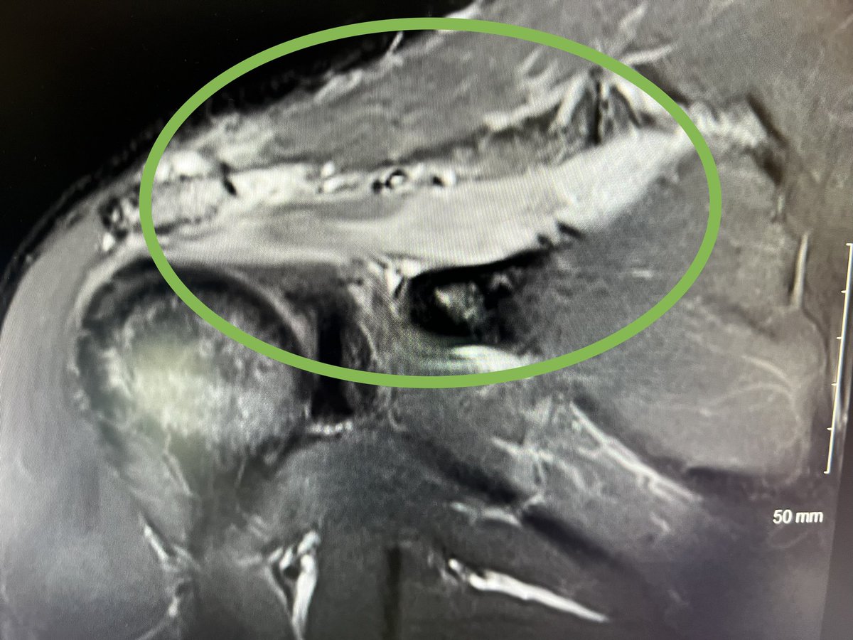 Shoulder Muscle lesions can act as a good predictor for cervical nerve entrapments.

This patient has supraspinatus wasting and fatty infiltration resulting from a C5 nerve root impingement (thus affecting suprascapular nerve). Also complains of general shoulder aching.