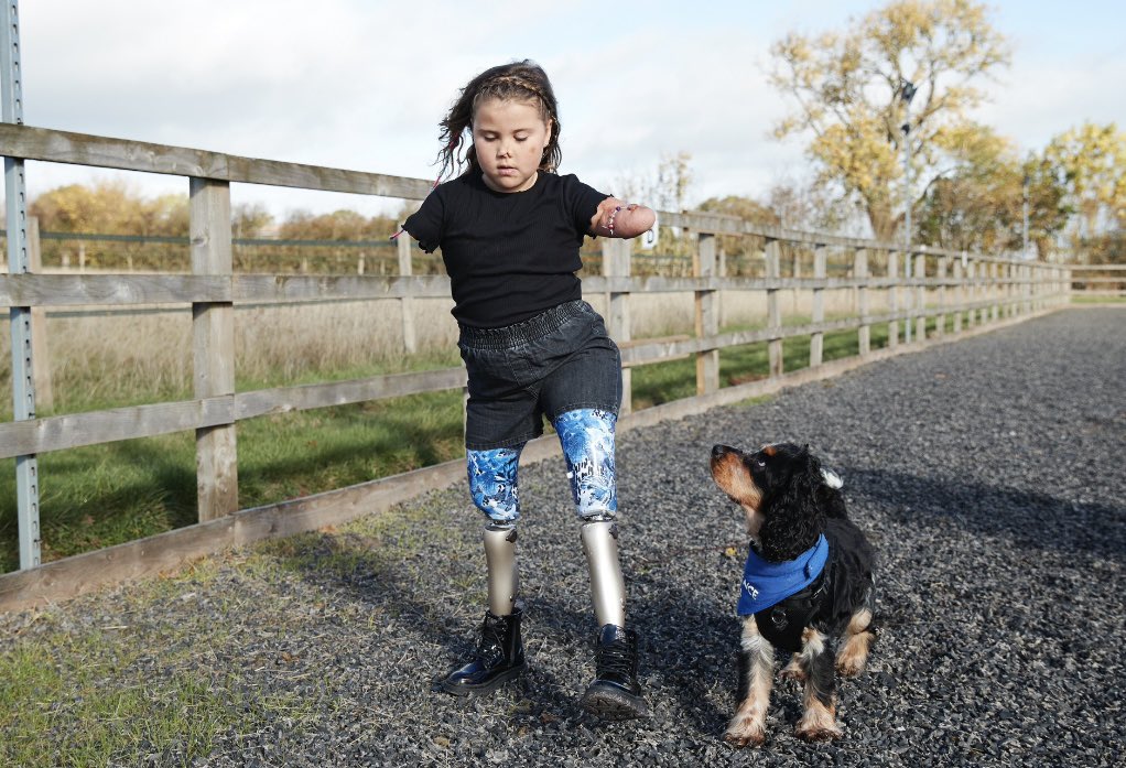 It’s amazing how a pair of legs can literally change your life! 

Harmonie Walked all the way home from school today for the first time ever! No wheelchair in sight!!! 

1 whole mile!!! 👏👏

#soproud #walking #prosthetics #smiles #laughter #happiness #hardwork #dedication