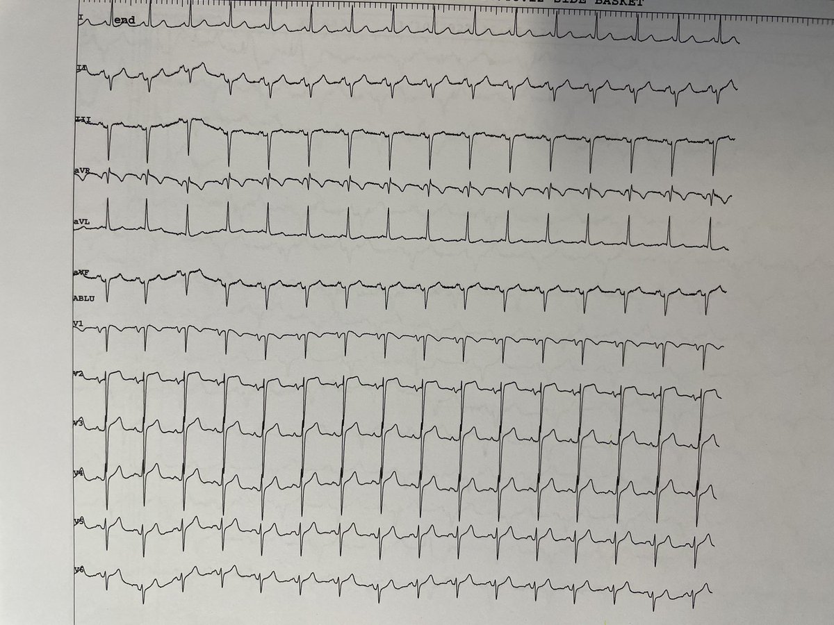 rfablation's tweet photo. 60 YO 35%EF persistent monomorphic VEB. #Nofluoro effective #RFablation in basal anterolateral #RVOT @messapus @PaoloDellaBell1 https://t.co/BM34MaIM0m