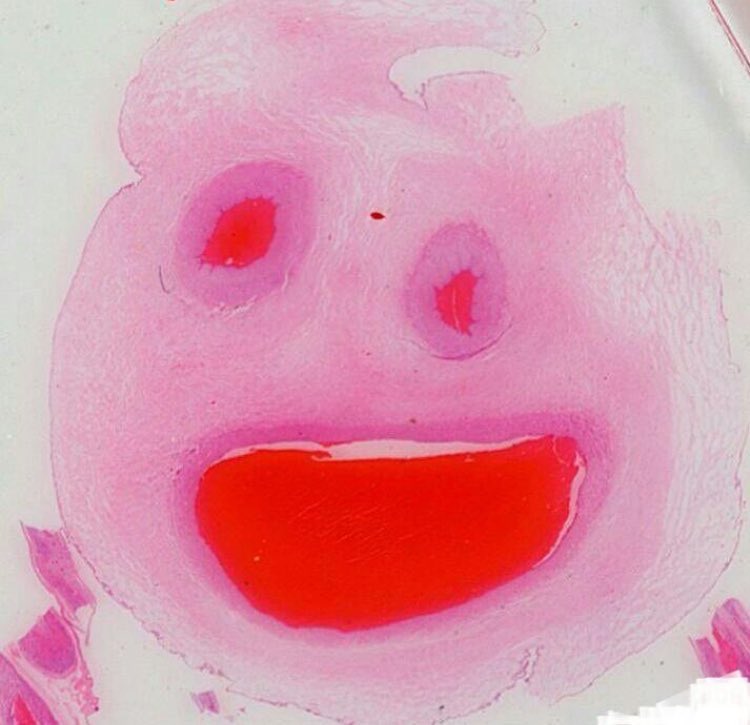 Bugünkü modum umplical cort gibi.