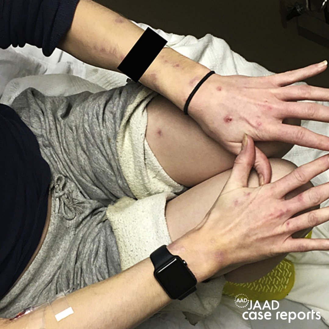AADmember's tweet photo. What's the #diagnosis? A 31-year-old intravenous heroin user, cat owner and self-described skin picker presented w/ 1-month history of a nontender, ulcerated forehead nodule... https://t.co/mhRXodj8eb

A. Bacillary angiomatosis
B. Pyogenic granuloma
C. Poroma
D. Picker's nodule https://t.co/OkcMlH2N32