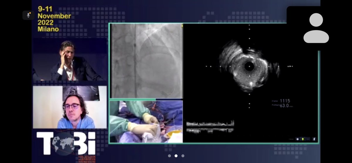 Stefan Harb (@stefan_harb) on Twitter photo “Is it safe to leave bleeding LAD with #CTO crossed but vessel partially expanded?”
“Shall we continue and finish such a case?”
Very practical questions addressed
at #TOBI22 Milano <a href="/tobicongress/">TOBI Total Occlusion Bifurcation Interventions</a> today
Come back tomorrow for another exciting day!
<a href="/RinfretStephane/">Stéphane Rinfret, MD SM</a> <a href="/luciotpadilla/">Dr. Lucio T Padilla🇦🇷</a> “Is it safe to leave bleeding LAD with #CTO crossed but vessel partially expanded?”
“Shall we continue and finish such a case?”
Very practical questions addressed
at #TOBI22 Milano <a href="/tobicongress/">TOBI Total Occlusion Bifurcation Interventions</a> today
Come back tomorrow for another exciting day!
<a href="/RinfretStephane/">Stéphane Rinfret, MD SM</a> <a href="/luciotpadilla/">Dr. Lucio T Padilla🇦🇷</a>