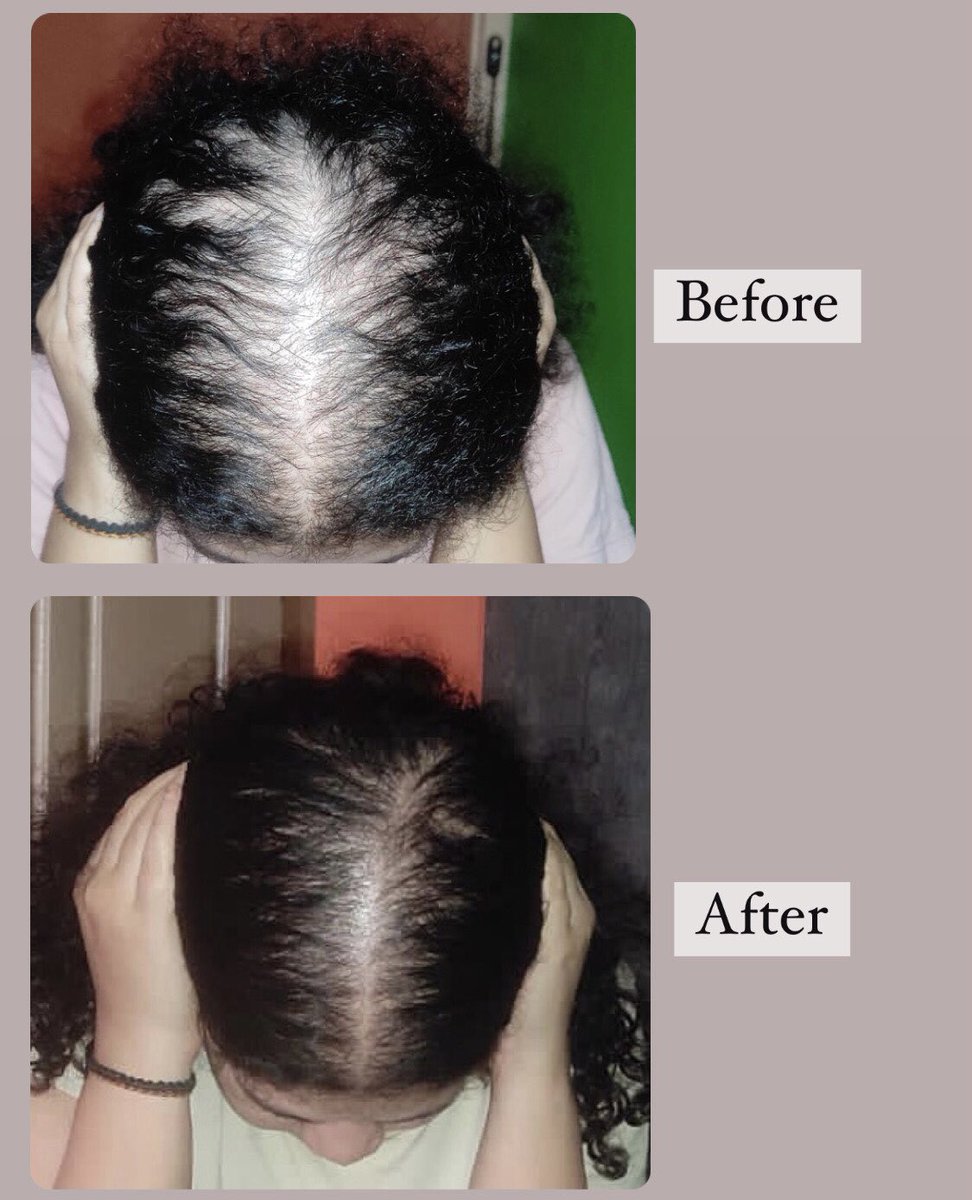 May be it’s time we start considering Ayurveda as choice to reverse hairloss and promote regrowth before making a jump to Minoxidil ?