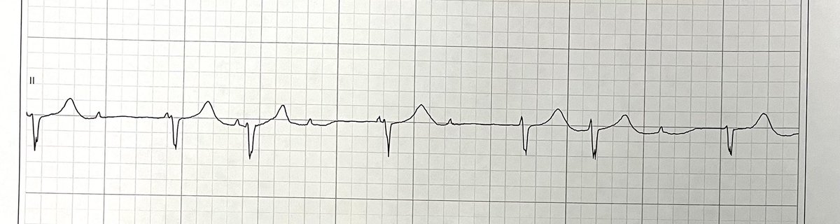 What is this rhythm 🎶 🥁 ? Pacemaker indicated? #Cardiotwitter #CardiologyFellows #Epeeps
