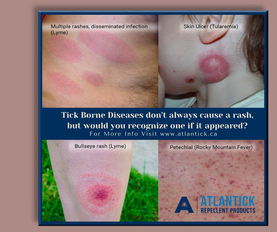 Would you recognize a tick bite related rash? #lyme #ticks