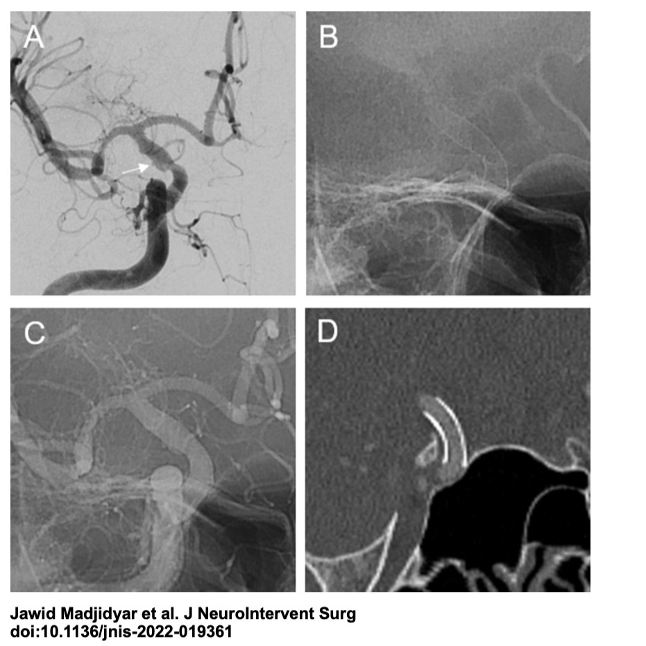 JNIS_BMJ's tweet photo. Latest in #flowdiversion- https://t.co/IvTAMhtQEw -Madjidyar J et. al report their experience with flow-diverter stent (FDS) reconstruction with single-antiplatelet therapy of ruptured cerebral blood blister and dissecting aneurysms. https://t.co/w7P1pP6WLb