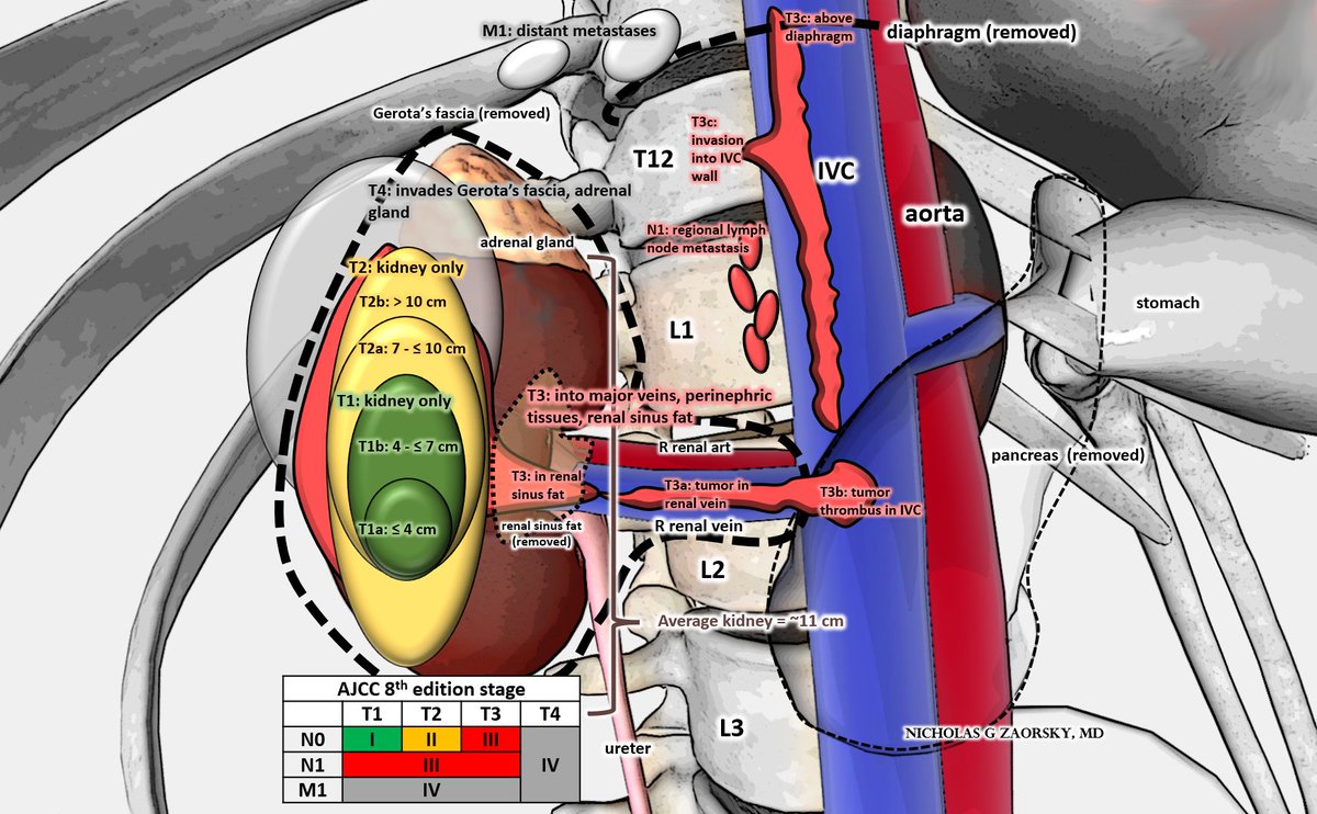 Kidney cancer staging in one figure.

#KidneyCancer
<a href="/AJCCancer/">AJCC</a> 8th ed