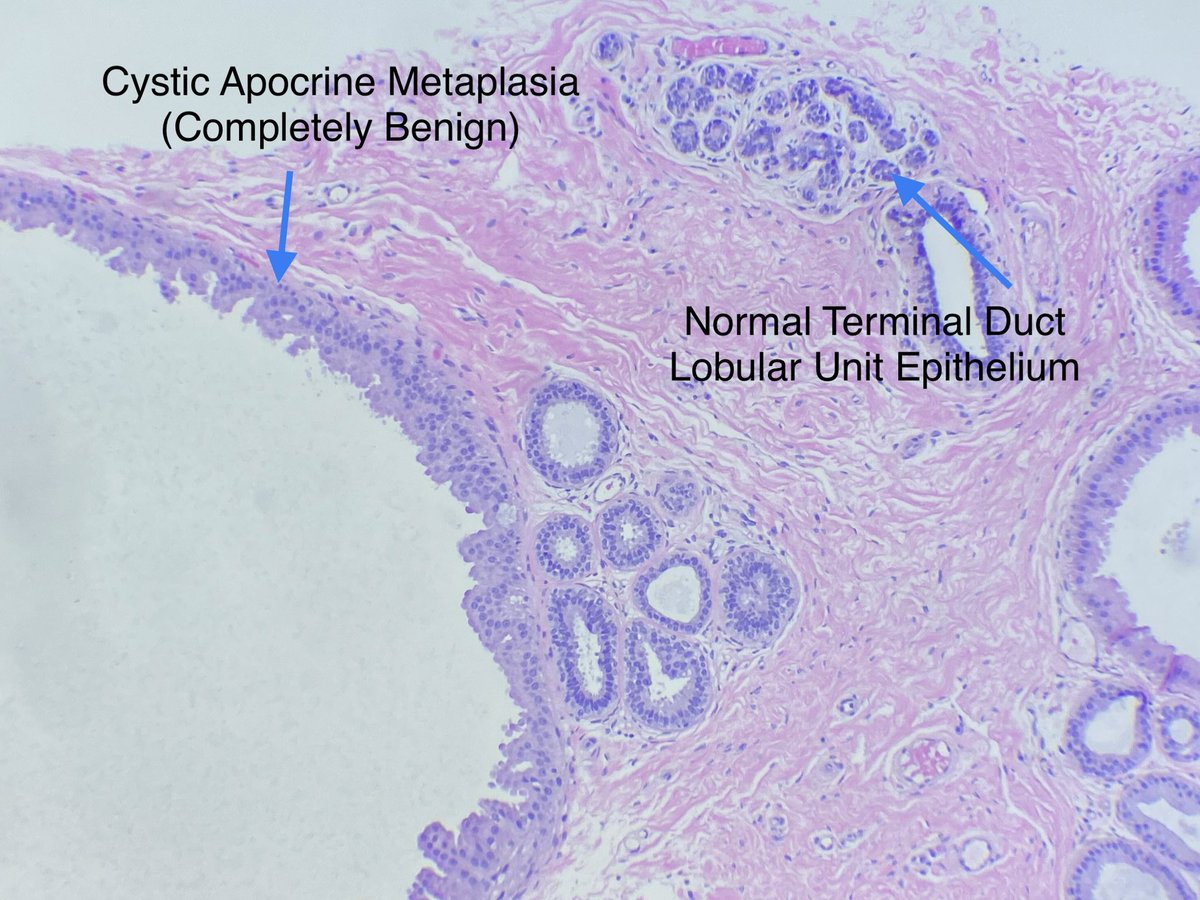 Alexander Damron, MD (@adamronmd) on Twitter photo My radiology buddy texts me. Hey man what is cystic apocrine Metaplasia? As a pathologist I felt required to respond histologically so this was my response 😂. #breastpath <a href="/DrGeeONE/">Olaleke Folaranmi</a> <a href="/QassidO/">Dr Omar Layth Qassid, FRCPath(UK) iFCAP(USA)</a> <a href="/jasmeet_assi/">Jasmeet A</a> <a href="/BCM_PathRes/">BCM_PathRes</a> <a href="/Chucktowndoc/">Frank Ingram, MD</a> <a href="/jennpincus/">Jenny Pincus, MD</a> <a href="/LizaMQuintana/">Liza Quintana, MD</a> #pathology My radiology buddy texts me. Hey man what is cystic apocrine Metaplasia? As a pathologist I felt required to respond histologically so this was my response 😂. #breastpath <a href="/DrGeeONE/">Olaleke Folaranmi</a> <a href="/QassidO/">Dr Omar Layth Qassid, FRCPath(UK) iFCAP(USA)</a> <a href="/jasmeet_assi/">Jasmeet A</a> <a href="/BCM_PathRes/">BCM_PathRes</a> <a href="/Chucktowndoc/">Frank Ingram, MD</a> <a href="/jennpincus/">Jenny Pincus, MD</a> <a href="/LizaMQuintana/">Liza Quintana, MD</a> #pathology