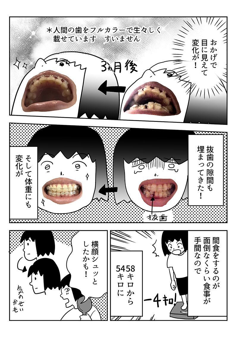 歯科矯正レポ漫画後編です🦷🦷
ついに本格的に器具をつけ痛みや苦労もあり口内がしっちゃかめっちゃかですがついに憧れの歯並びを手に入れました!
頑張ってよかった!
今はせんべいもお餅もなんでも食べられます🍘
https://t.co/aZKubHMjoq 