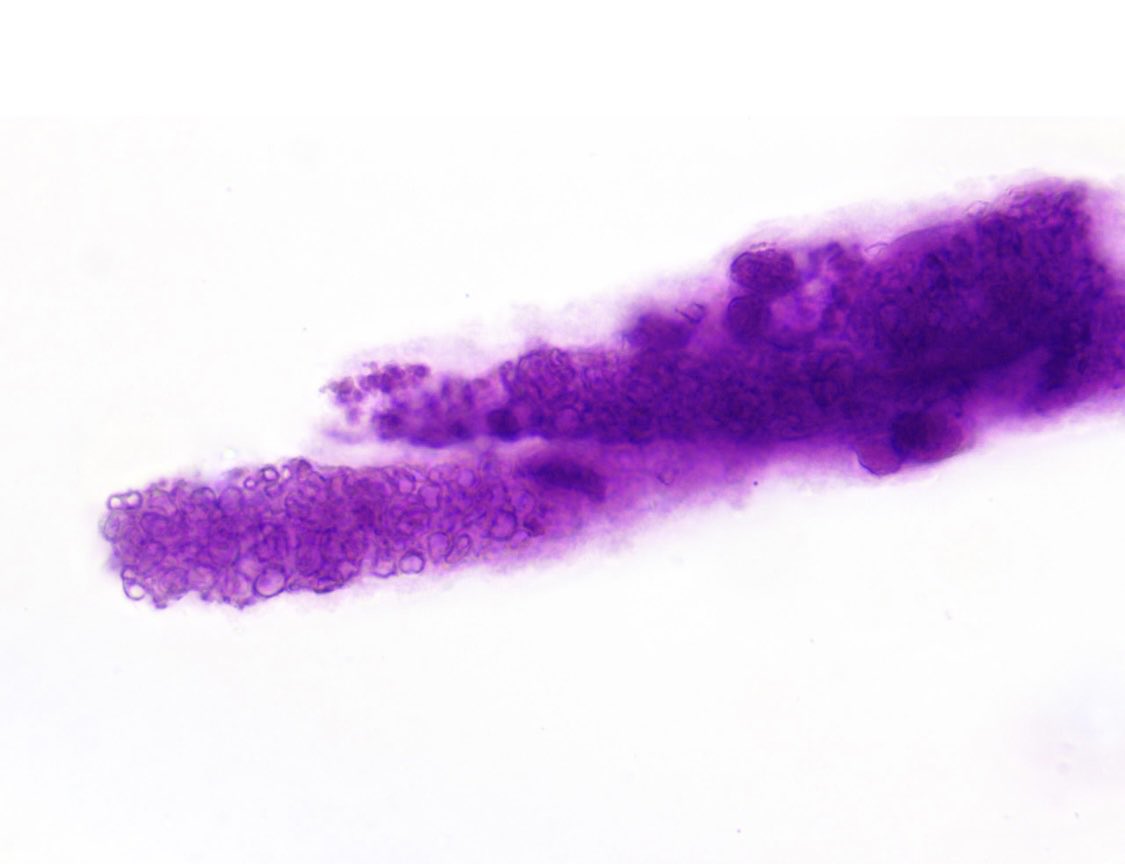 SwethaKanduriMD's tweet photo. Was able to spot an RBC cast on the urine sediment of a patient with pauci immune necrotizing GN with endocarditis. #SpinUrine #RBCCast #Urinemicroscopy https://t.co/kqfMC9FL93