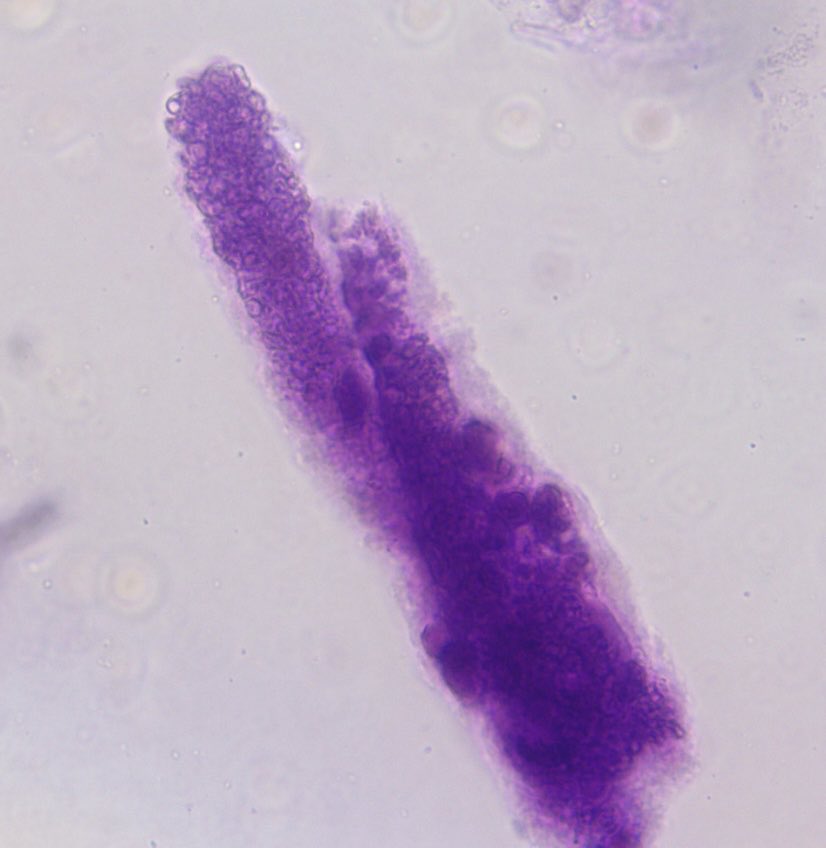 SwethaKanduriMD's tweet photo. Was able to spot an RBC cast on the urine sediment of a patient with pauci immune necrotizing GN with endocarditis. #SpinUrine #RBCCast #Urinemicroscopy https://t.co/kqfMC9FL93