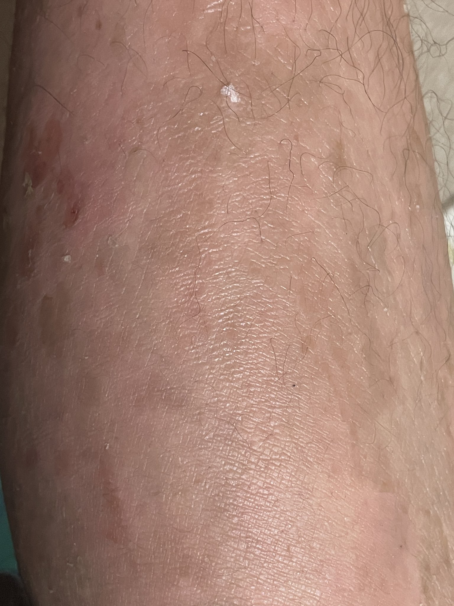 魚鱗癬 Twitter Search Twitter