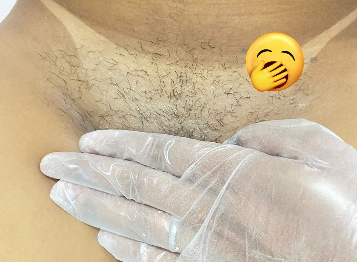 Jaqueli43696987's tweet photo. Antes e depois! Segunda sessão de epilação da cliente, Pele lisinha e maior durabilidade só com epilação na cera (foto tirada com autorização da cliente). 🍯😊 Custa 0,00 Dar Rt/fav no trabalho da amiga aqui! https://t.co/jrL2opC1x9