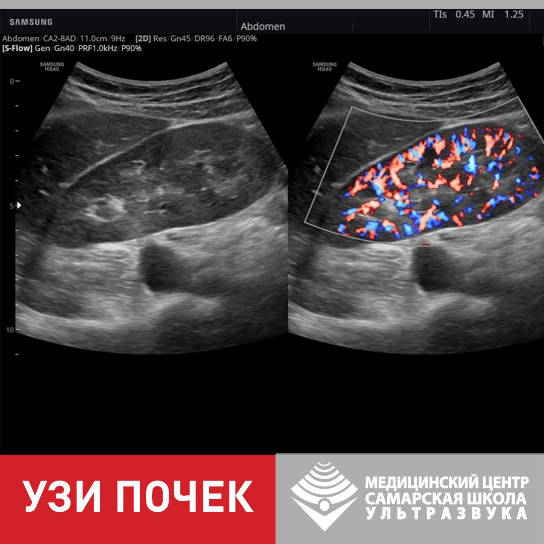 Аппарат УЗИ самсунг HS 40