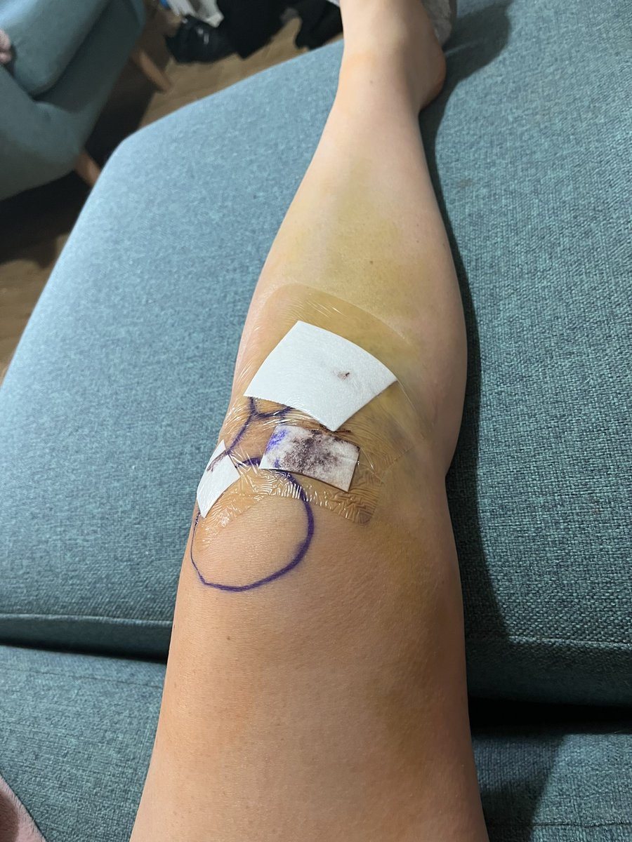 CarysPhysio's tweet photo. Day 4 post ACLR:
Main problems; adductor &amp; calf pain, almost 0% sensation around medial calf/ankle - assuming my saphenous nerve took a hit. Back pain definitely flaring with the lack of activity. Surprisingly the knee feels like the best part of me (&amp; looks like a rainbow) https://t.co/7YvbjhgGVA