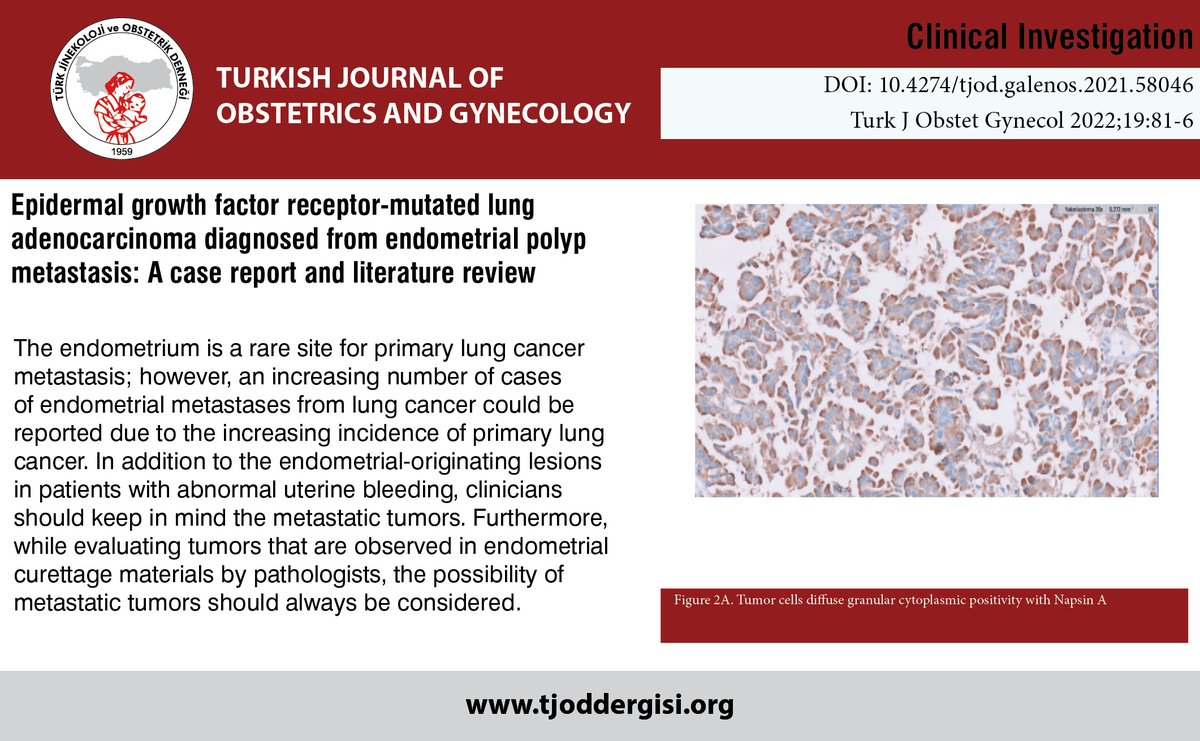 TJODOfficial's tweet photo. Epidermal growth factor receptor-mutated lung adenocarcinoma diagnosed from endometrial polyp metastasis: A case report and literature review

You can see the free full text of the research by Pınar Bulutay et al.

Link : https://t.co/gxozfVS5LV https://t.co/Q630bnSgxT