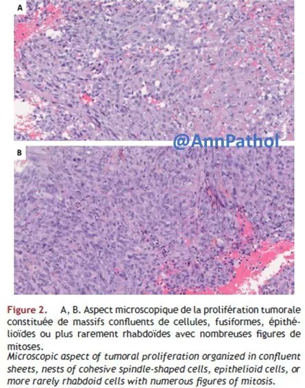 Annpathol's tweet photo. 🇫🇷 Patient de 51 ans avec douleurs péniennes, se compliquant… Diagnostic ?
🇬🇧 51-year-old patient with penile pain, complicating... Diagnosis?
#GUPath #PenisPath #BSTPath #francophonepath https://t.co/LVInfCAUaU