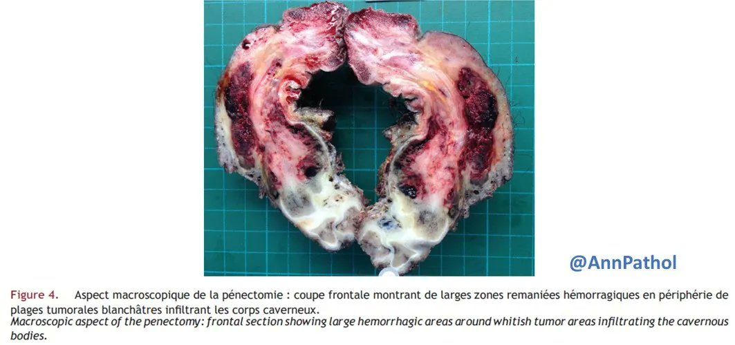 Annpathol's tweet photo. 🇫🇷 Patient de 51 ans avec douleurs péniennes, se compliquant… Diagnostic ?
🇬🇧 51-year-old patient with penile pain, complicating... Diagnosis?
#GUPath #PenisPath #BSTPath #francophonepath https://t.co/LVInfCAUaU