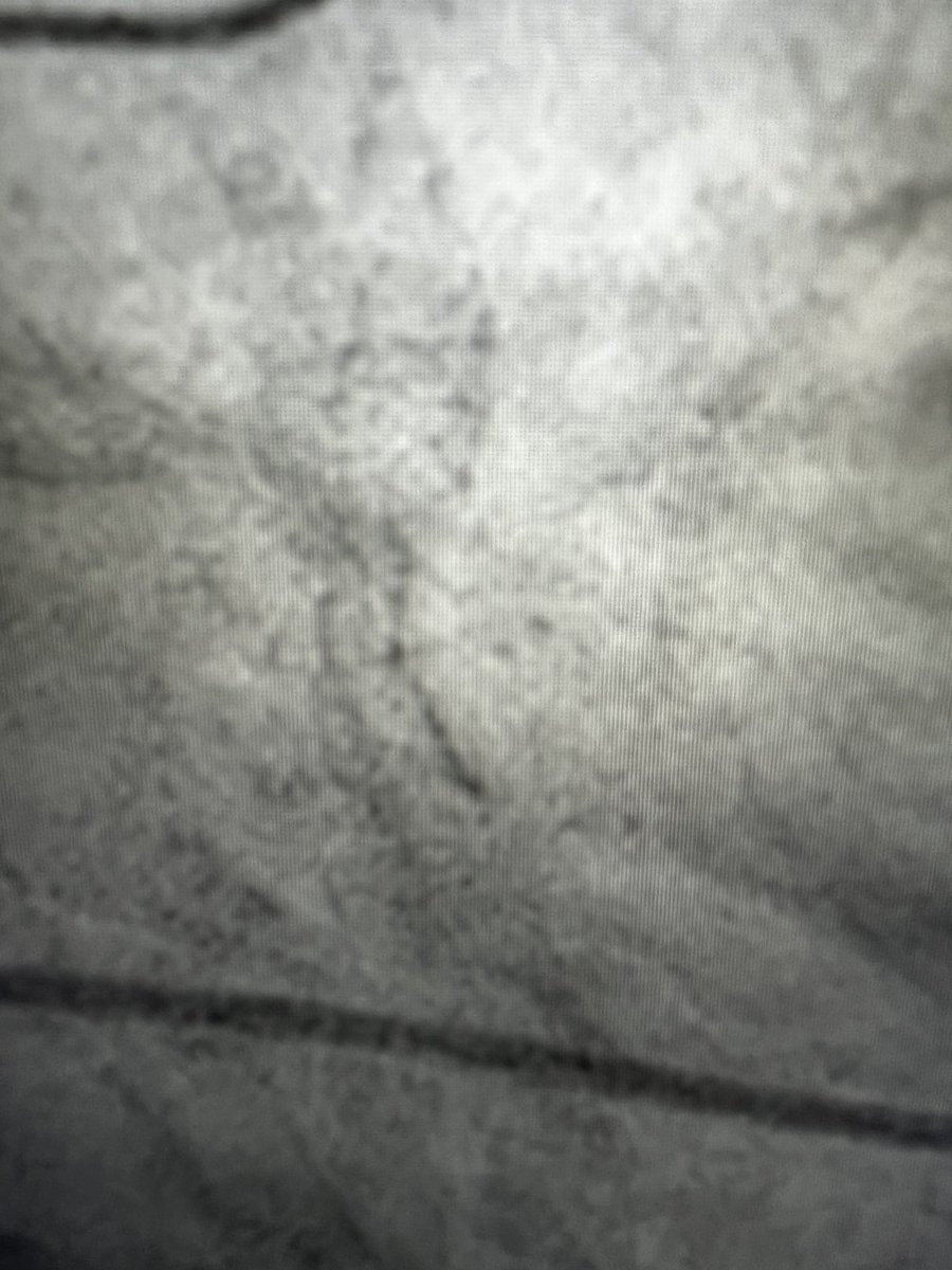 Plea to all my Interventional Cards community: please IVUS or OCT every #ISR or balloon and refer if you do not have #IVUS/OCT. 45% of ISRs are mechanical failure. Putting another stent before solving the old stent under expansion is not nice