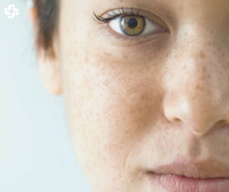 SkinBodyRenewal's tweet photo. If you’re bothered by dark spots due to hyperpigmentation on your skin, one thing is clear: Today, there are more options for erasing that harmless but bothersome discolouration than ever before https://t.co/e8pQmNt7iX #SkinRenewalSA #pigmentation #hormones #melasma https://t.co/39a7Qay1l1