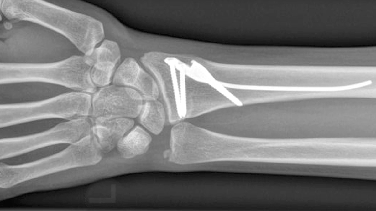 AOFoundation's tweet photo. On this #InnovationsFriday, we introduce the AO approved Distal Radius Intramedullary Nail (DRIM-Nail) indicated for the fixation of extra-articular fractures of the distal radius. 

Read more ➡️ https://t.co/GignDgrO6w https://t.co/UfWvWseGzu