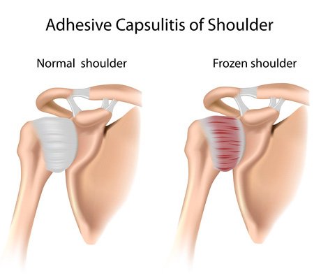 aziz_h1985's tweet photo. #آلام_الكتف المتجمدة
Adhsive Capsulitis ( frozen shoulder)
هو الشعور بالتيبّس والألم في مفصل الكتف مع عدم القدره على تحريك الكتف يزداد ليلاً و يأثر على النوم ونوعيته.
تحدث الإصابة بالكتف المتجمدة عندما يزداد سُمك الكبسولة النسيجة الضامة وتضيقها حول مفصل الكتف، ما يقيد حركته. https://t.co/tMw8j9ZPXw