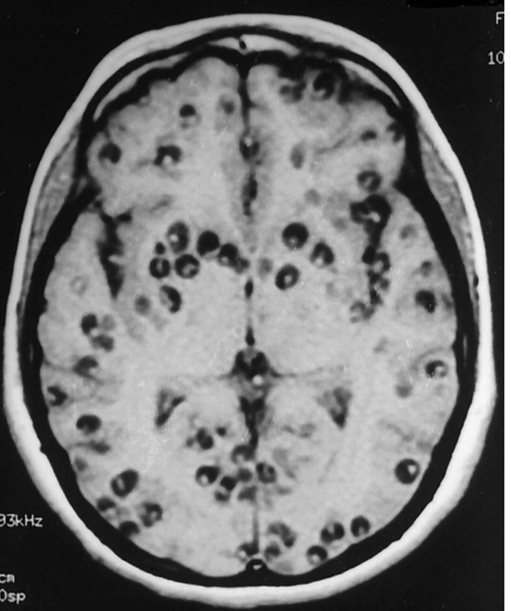 Patient had a ground level fall w/ incidental findings on head CT leading to this MRI. What do you see? What is treatment? #neurosurgery #neurology #neuroscience #neurotwitter #neuroradiology