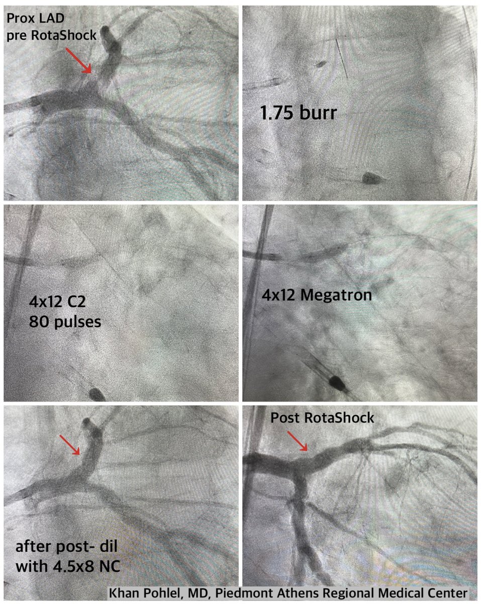 ShockwaveIVL's tweet image. Dr. @KPohlel of @PiedmontHealth Athens Regional faced an unyielding LAD. Unable to cross the lesion the prior day, he switched to the #RotaShock technique, crossing the lesion with a 1.75 rota burr and then cracking the calcium with 4.0 #ShockwaveC2.

ISI bit.ly/3iEq7fC