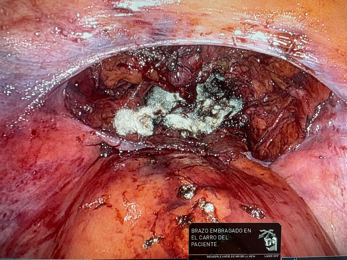 miriamcampistol's tweet photo. First Retzius-sparing robot assisted radical prostatectomy performed by @Jacquesplanas  at @vallhebron 🏥

Thanks to @agalfano for all his important tips🙌🏻 https://t.co/KEwEvSD34m