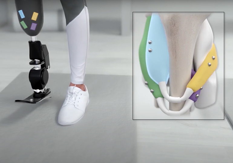 SulisTechnology's tweet photo. Implanted Magnets for Prosthetic Control

Engineers at MIT have developed a system that could let users of robotic prostheses to more sensitively control their bionic limbs. The technology involves implanting pairs of small magnetic beads into muscl…
https://t.co/lYpIf0q1Te https://t.co/huAtK0XHhr