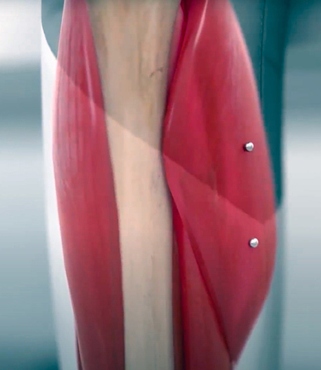 Implanted Magnets for Prosthetic Control

Engineers at MIT have developed a system that could let users of robotic prostheses to more sensitively control their bionic limbs. The technology involves implanting pairs of small magnetic beads into muscl…
medgadget.com/?p=1540873&utm…