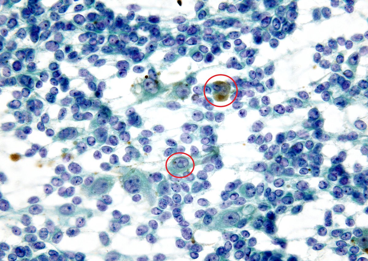 Breast mass with a slam dunk "Melanoma". (FNA)