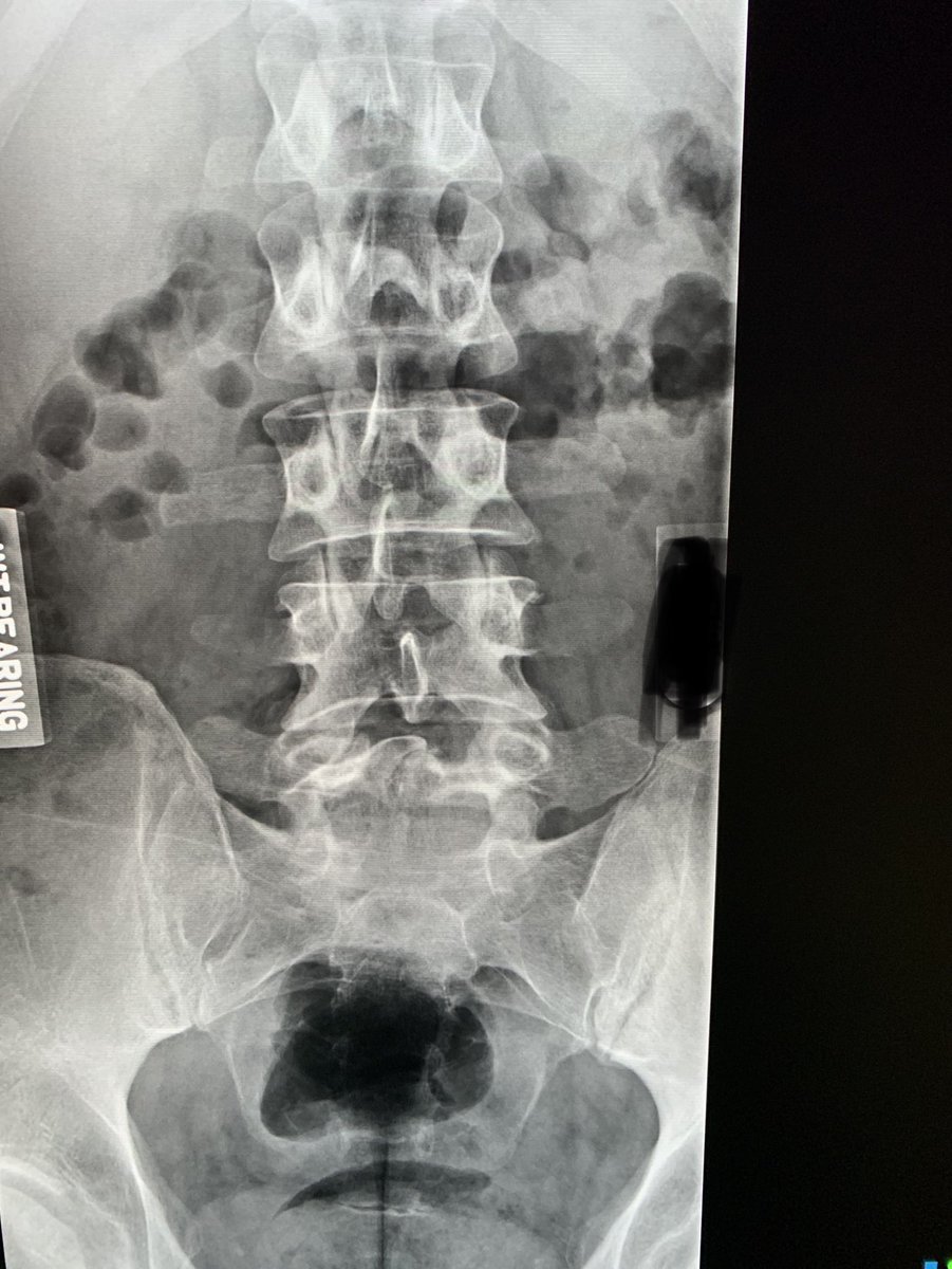 northwoods1980's tweet photo. Younger patient. Low back pain. Can you spot it? https://t.co/frfX0oGPoX