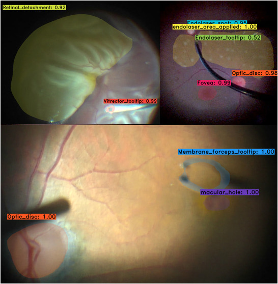 AAOjournal's tweet photo. This study demonstrated that deep learning neural networks can track and segment instruments and tissues in real time when attached to a surgical microscope during vitreoretinal procedures. https://t.co/vIZofFbz32
@rgnespolo @VR_Surgeon @DarvinIsTrying https://t.co/tr0cwIfmym