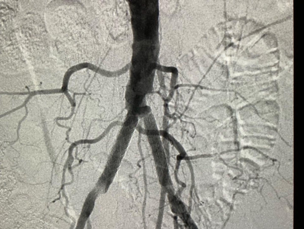 DocIfti's tweet image. Treatment of iliac disease in a long term smoker who presented with claudication. Treated with shockwave and VBX stents. 
 @SIRspecialists @Interventional2 @SIRRFS
