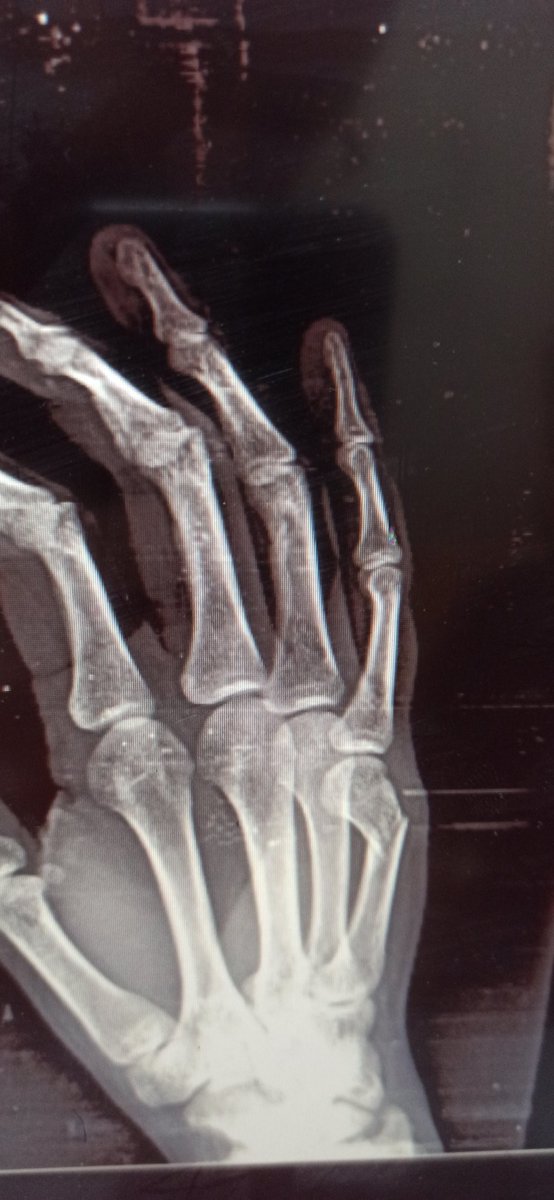 سخريه القدر ان تاني يوم في اللعب و الحياه الصحيه ان يحصلي كسر غير لطيف في ايدي اليمين يفرتك خططي كلها في الحياه الصحية و الدراسية و العملية لأجل غير مسمي و يغير خطط كتير ،، ندعي كلنا انها متعوزش جراحة ولا تسيب تشوه في اليد 
شكراً لمستشفي الساحل التعليمي و نوابها ❤️