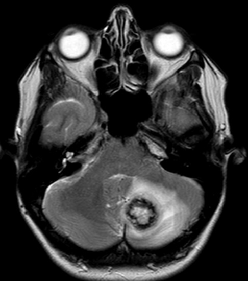 draceciferrario's tweet photo. #casefollowup for those who remember the patient with the hypervascular lung lesion and history of abortion... 
She returned to the ER with headache, vertigo and vomiting.
These were the findings of the brain MRI. She underwent urgent surgery due to risk of herniation... https://t.co/3WSYTuEHnl