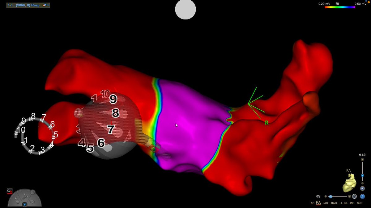 dr_pmueller's tweet photo. #Epeeps, exciting #Heliostar RF-Balloon+LassostarNAV arrived @KKliniken. Impressive 1st RF🔥Ballon #PVI cases @ #EPVest ➡️ safe&amp;fast. Great opportunity to combine single-shot tech + 3D-Map.

Excellent support @BiosenseWebster @Marinaschaefe @MarliSchuBat @PNaber6 @lars_brueckner https://t.co/Anv13uvy4v