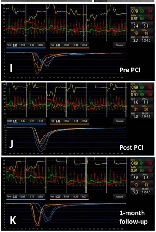 Impact of rotational atherectomy on coronary microcirculation was assessed by index of microcirculatory resistance (IMR). The IMR increased after rotational atherectomy from 19 to 31 (I, J), resulting in the deteriorated coronary flow reserve (CFR) despite the improved fractional flow reserve (FFR). 

One-month later, the IMR eventually recovered to 13 (K), suggesting that the influence of stent ablation on the coronary microcirculation was limited and temporary!!!