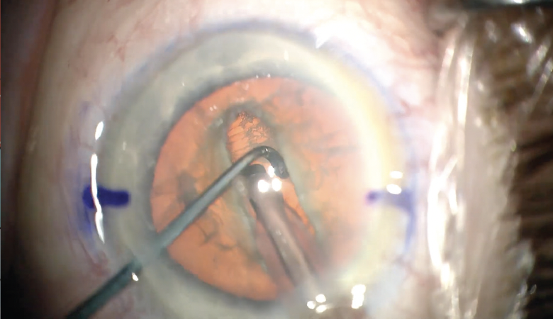 CRSToday's tweet photo. Part divide + conquer and part stop + chop, my technique begins with creating a groove down the middle of the #cataract that is the width of 1-2 #phaco tips. The nucleus is rotated 180º, the groove is extended, and the nucleus is cracked. @HimaniGoyalMD  https://t.co/DixWqWFTKb https://t.co/gbM5v9AXQv