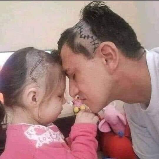 BambiniConverse's tweet photo. Un papà si tatua la “cicatrice” come la sua bambina per accompagnarla nel difficile momento che sta attraversando ❤
#12novembre #tatuaggio #musk https://t.co/tpbfISD5yu