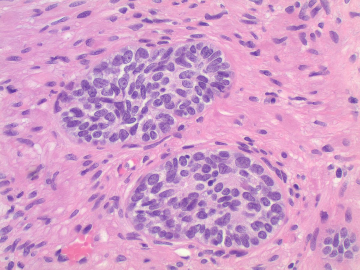 #GUpath: TURP for clinical BPH 🔬basal cell hyperplasia #beautyinb9 (also 😈mimicker of pros ca!)