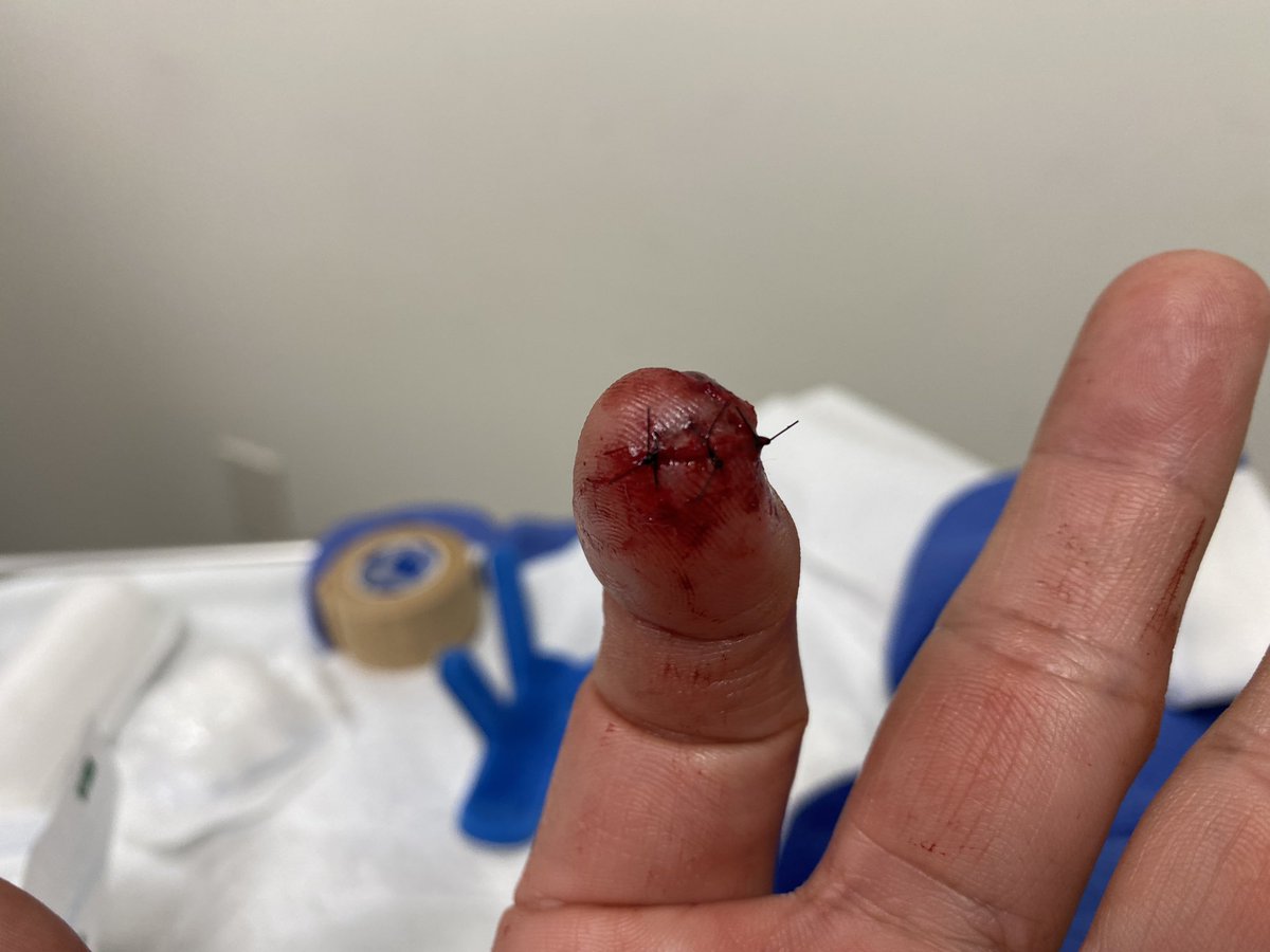 Table saw finally bit me.  I got lucky it didn’t cut the tip of my finger off.  #laceration #tablesaw #stiches #safety #blood #needle