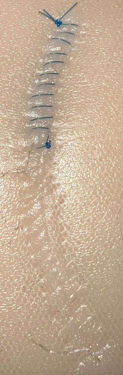 DoctorPetruzzo's tweet photo. Newest running stitch! I would have liked better margins, but I was trying to focus on not pulling the skin so much more than the margins this time. Also, I ran out of the clear suture partially through, so I had to continue with 3-0 nylon:) https://t.co/Ki2B3DMjYc