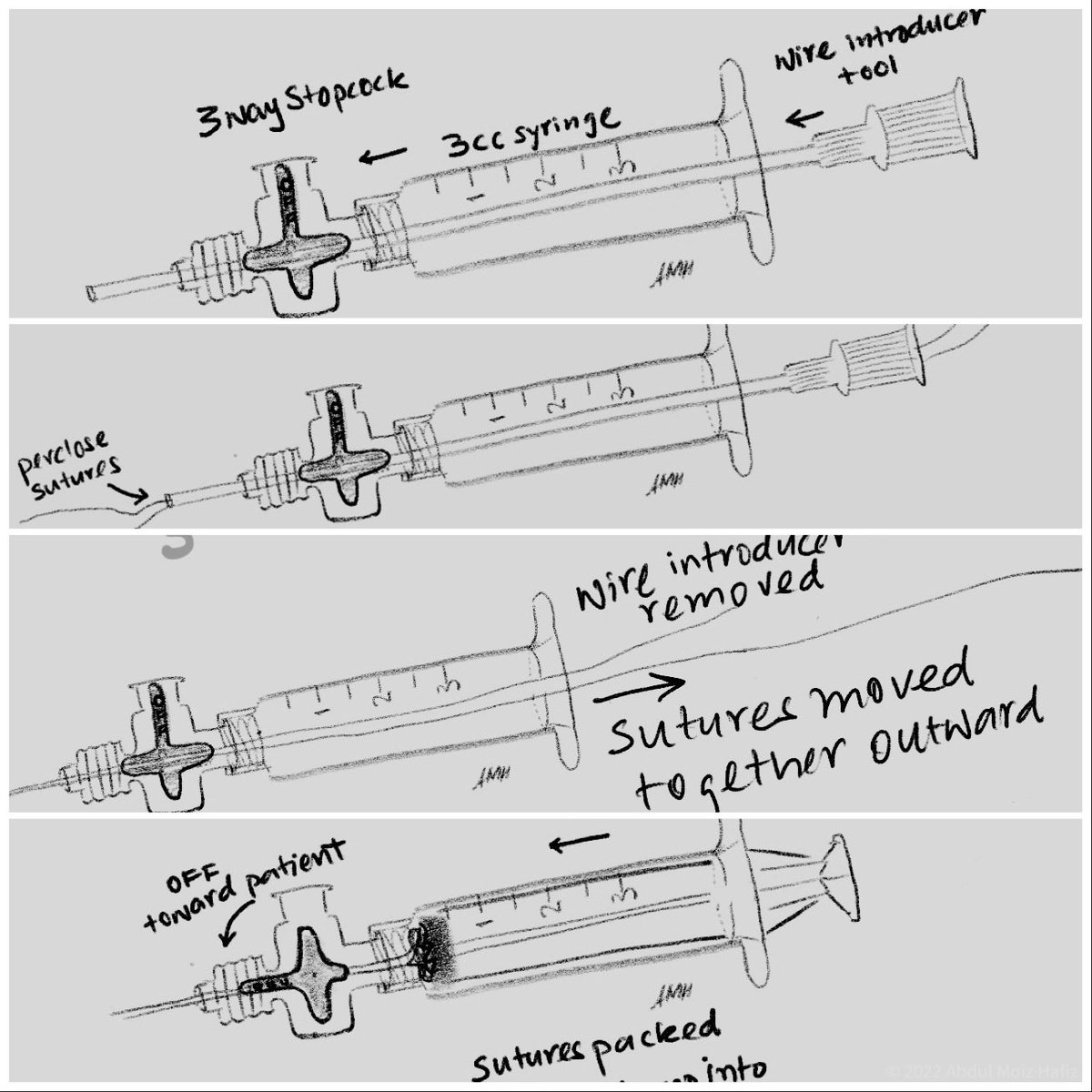 How do you secure preclose sutures in sterile fashion for later impella removal. Here is a simple suggestion ⁦⁦⁦with step by step diagrams for⁩ #ACCFIT ⁦<a href="/IllinoisACC/">IllinoisACC</a>⁩ ⁦<a href="/SCAI/">SCAI</a>⁩ ⁩If you have a better way add a reply!