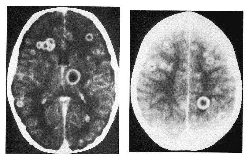 Туберкулез головного. Абсцесс головного мозга кт. Абсцесс головного мозга мрт.