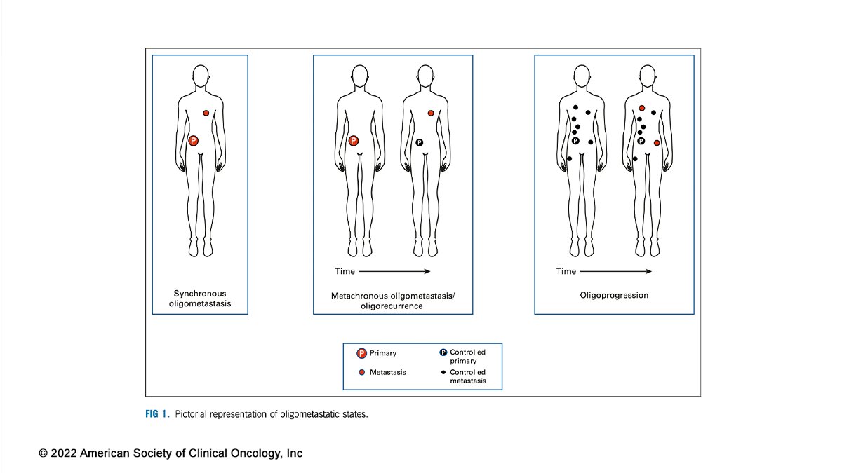 🗒️ #JCO #ReviewArticle - @weiliuRO @houdabahig <a href="/drdavidpalma/">David Palma, MD, PhD</a> summarize new data and future directions in treating #oligometastases ➡️ fal.cn/3txNe #radonc #surgonc