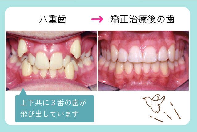 八重歯 Twitter Search Twitter